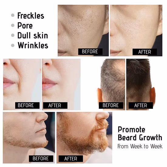 Venda imperdível marca própria Matt Micro Needle Matte Black 540 Derma Roller